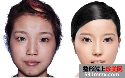 塌鼻子,隆鼻,前后,对比,效果,图片