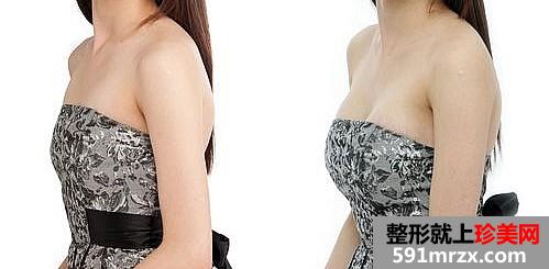 乳房悬吊术,前后,对比,效果,图片