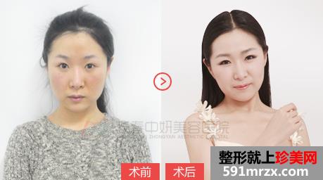 激光,祛痘疤,前后,对比,效果,图片