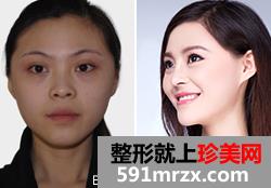 自体脂肪活细胞丰额头前后对比效果图片