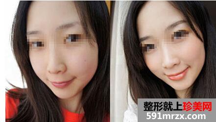 皮肤,激光,美白,前后,对比,效果,图片