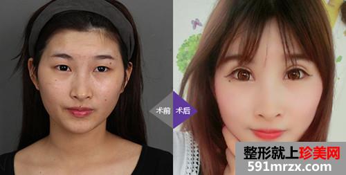 纯韩,睛灿,媚眼术,前后,对比,效果,图片,恢复,过程