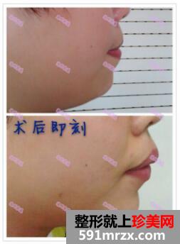 沧州,京美,丰下巴,让我,终于,摆脱,短下巴,缺陷