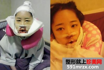 颜面,轮廓,整形,双颚,手术,恢复,过程,前后,对比,效果图