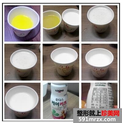 颜面,轮廓,整形,双颚,手术,恢复,过程,前后,对比,效果图