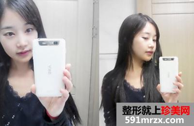 颜面,轮廓,整形,双颚,手术,恢复,过程,前后,对比,效果图