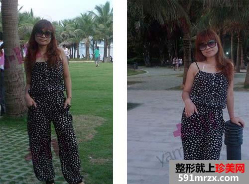 长沙雅美打保妥适瘦脸针手术恢复过程及前后对比效果图片