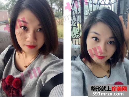 瘦脸针瘦脸第五天效果，咬肌不酸了但还是不能吃硬东西