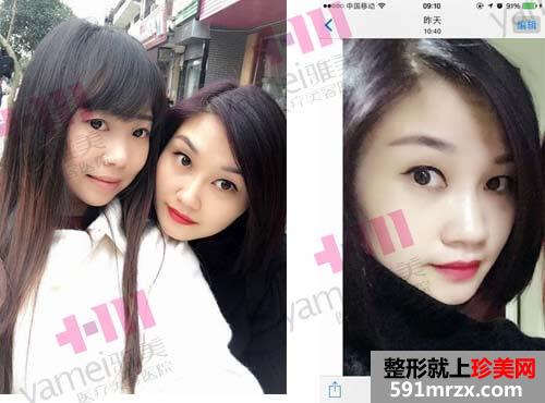注射瘦脸针后的第18天，朋友都说变漂亮了