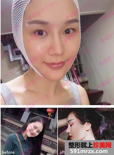 长沙雅美埋线提升女士案例
