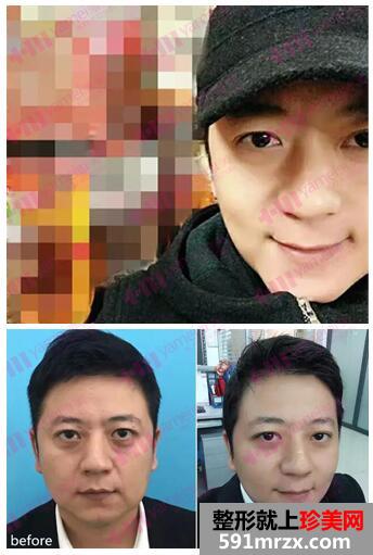 长沙雅美埋线提升男士案例