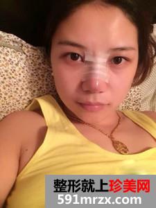 塌鼻子,隆鼻,前后,对比,效果,图片,恢复,过程