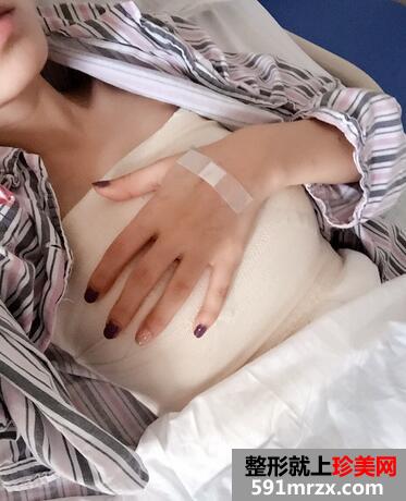 上海九院假体隆胸案例 假体隆胸恢复后图片