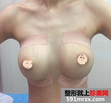 上海九院假体隆胸案例 假体隆胸恢复后图片