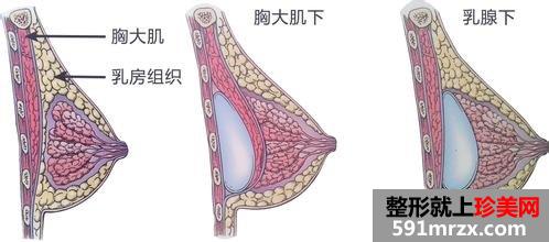 上海曼托假体隆胸的价格手感怎么样