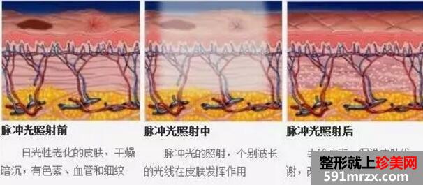 光子嫩肤原理
