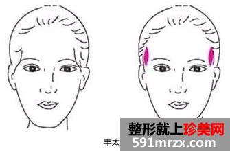 丰太阳穴多少钱效果好不好