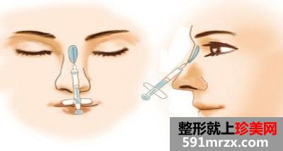 非手术隆鼻多少钱效果好不好