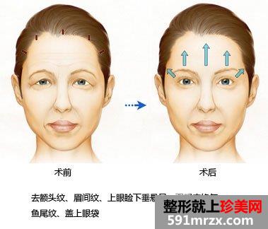 去抬头纹最好的方法玻尿酸去抬头纹