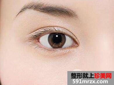 生物焊接双眼皮价格恢复时间