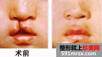 如何治疗兔唇兔唇的治疗效果