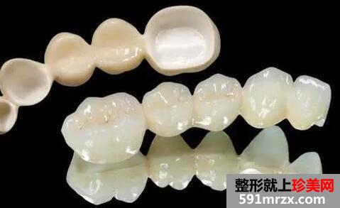 一口烤瓷牙多少钱