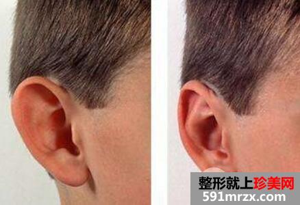 北京招风耳手术多少钱