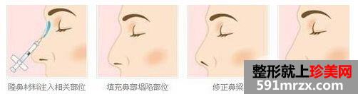 伊维兰隆鼻价格