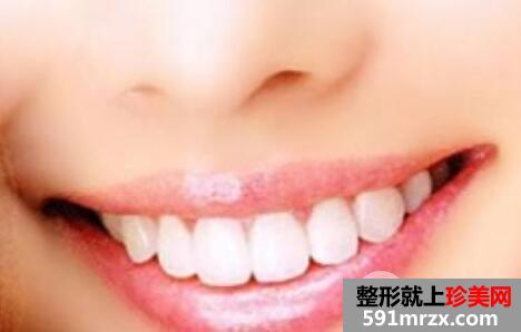 烤瓷牙多久换一次