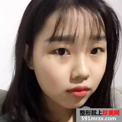 做完双眼皮手术，清纯妹纸秒变气质女神！