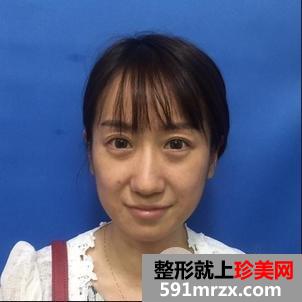 治疗鱼尾纹的方法_案例分享，附上海华美整形美容医院价格详情