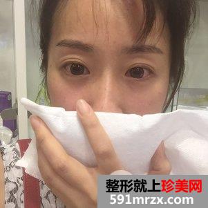 治疗鱼尾纹的方法4