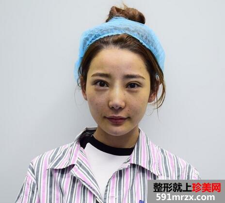 【隆鼻修复】埋线隆鼻恢复过程_术前术后对比图
