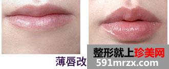 薄唇改厚,前后,对比,效果,图片
