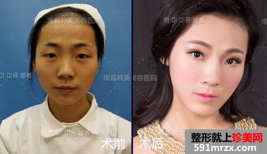 韩式,精雕,双眼皮,耳软骨,垫鼻尖,假体垫下巴,前后,对比,效果,图片