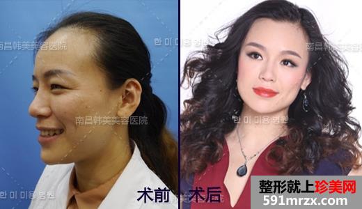 注射,botox,除皱,前后,对比,效果,图片
