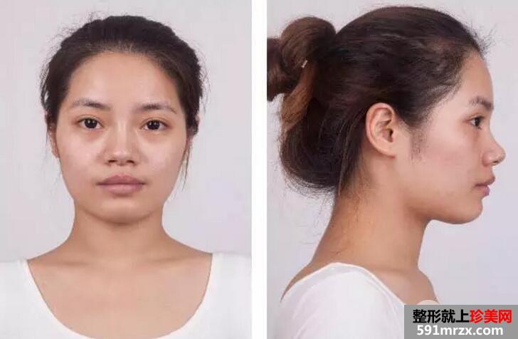 鼻部整形成功案例真人照片假体隆鼻效果对比图