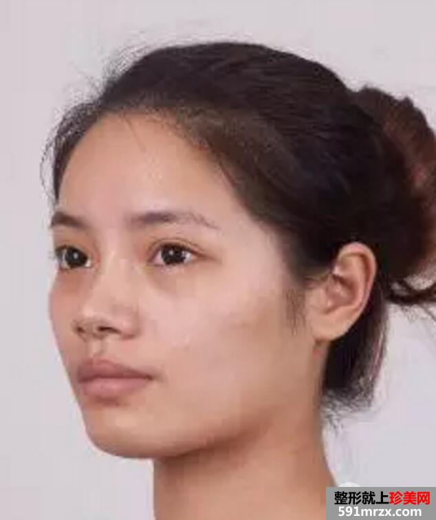 鼻部整形成功案例真人照片 假体隆鼻效果对比图