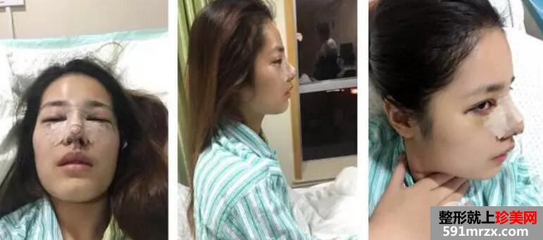 鼻部整形成功案例真人照片 假体隆鼻效果对比图