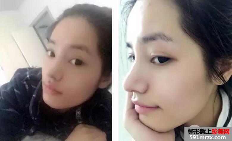 鼻部整形成功案例真人照片 假体隆鼻效果对比图
