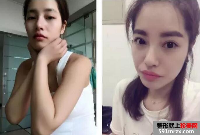 鼻部整形成功案例真人照片 假体隆鼻效果对比图