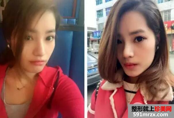 鼻部整形成功案例真人照片 假体隆鼻效果对比图