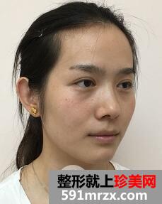 美白针整形案例