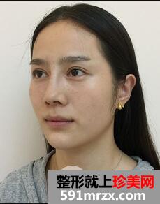 美白针整形案例