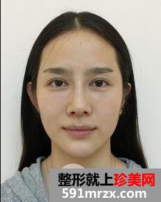 美白针整形案例