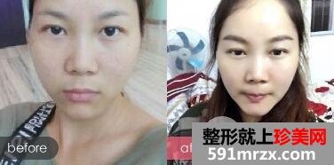 眉毛种植效果图3个月案例分享