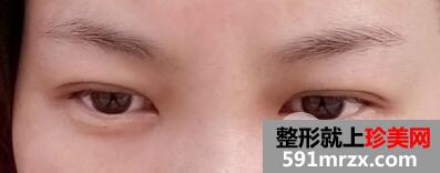 眉毛种植效果图3个月案例分享