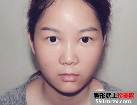 眉毛种植效果图3个月案例分享