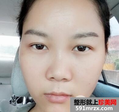 眉毛种植效果图3个月案例分享