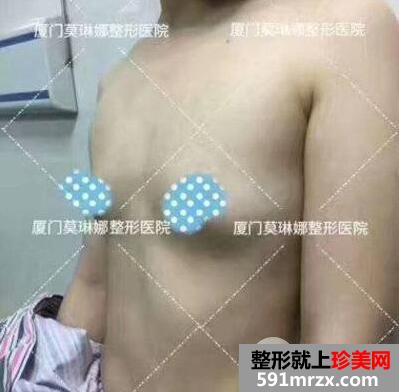 娜琦丽假体隆胸案例，附上前后对比图